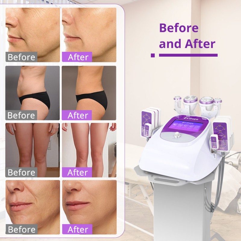 S Shape Cavitation 2.5 160MW Laser Lipo Body Shaping Device