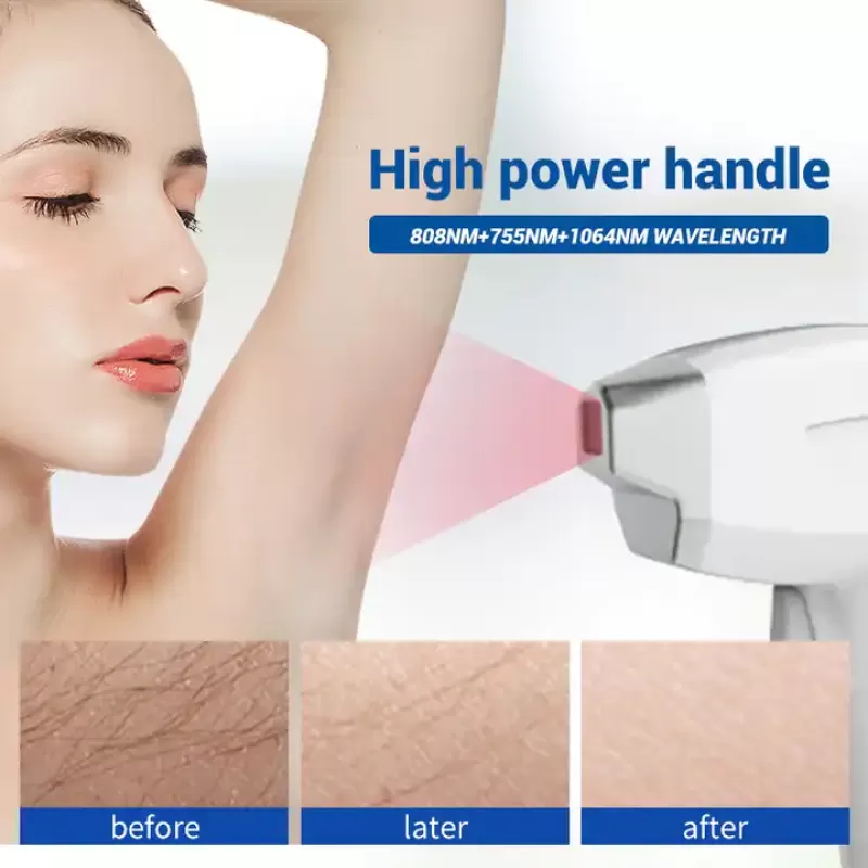 Professional 755 808 1064 Permanent Diode Laser Hair Removal Machine