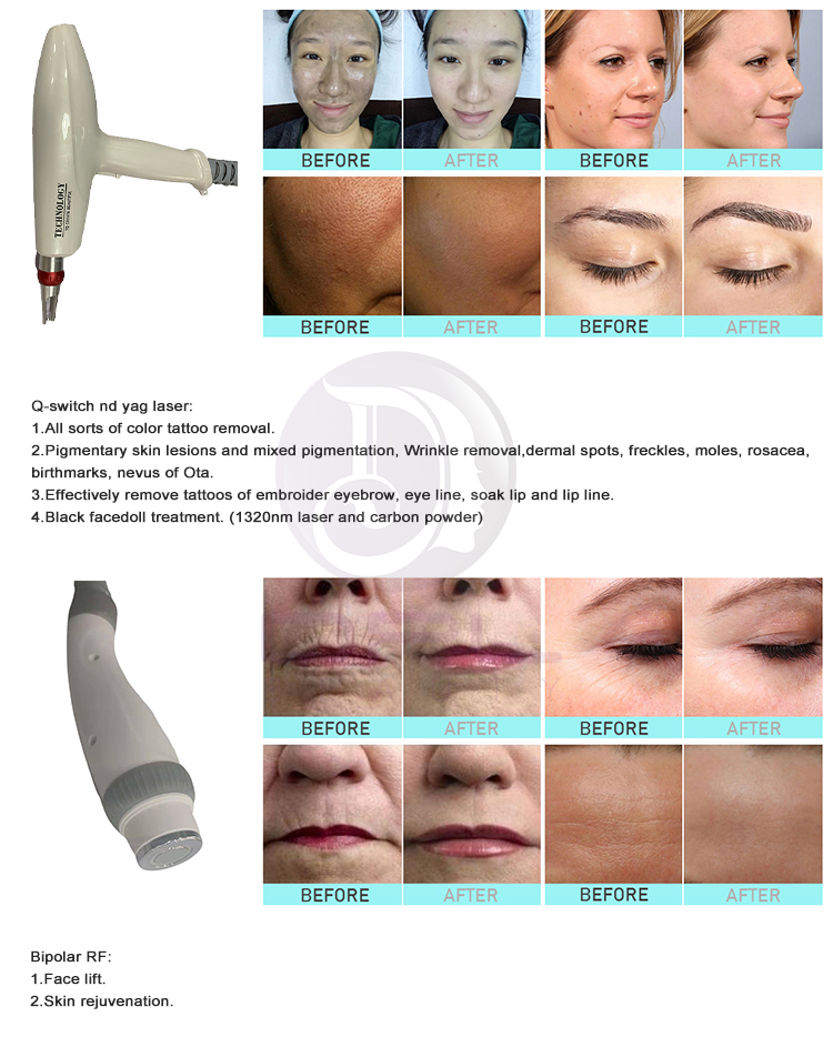Ipl Parameters Multifunctional 4 In 1 IPL Yag Laser RF Tattoo Hair Removal Machine