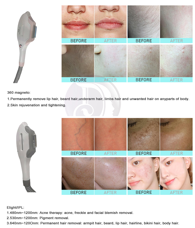Ipl Parameters Multifunctional 4 In 1 IPL Yag Laser RF Tattoo Hair Removal Machine
